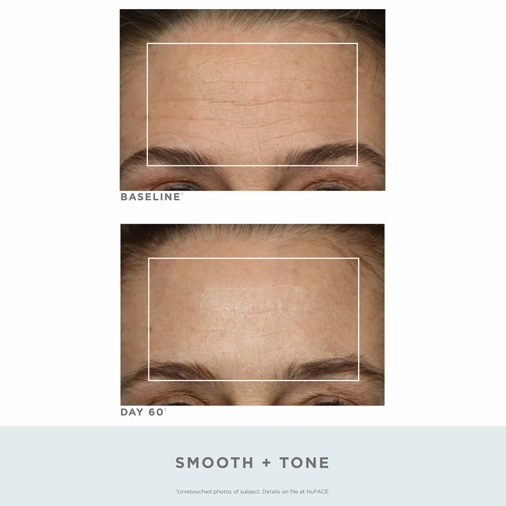 NuFACE Trinity Wrinkle Reducer Red Light Therapy Attachment 5 NuFACE Trinity Wrinkle Reducer Red Light Therapy Attachment