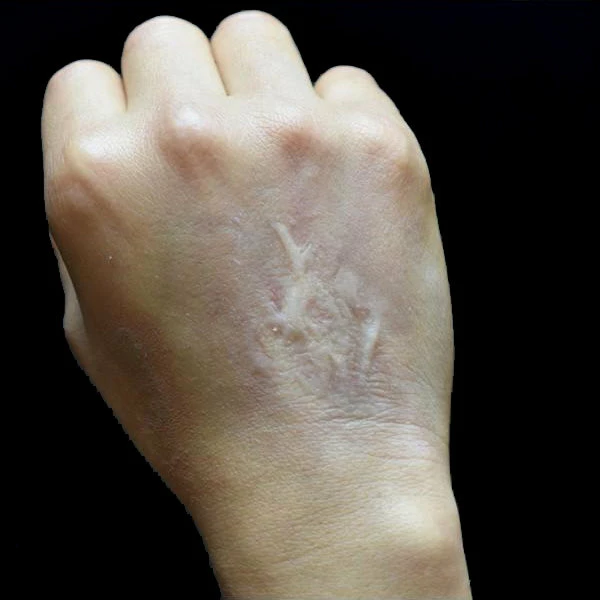 Out Of Kit Healed Burn Scar 1 Special FX 2 Out Of Kit Healed Burn Scar 1 Special FX