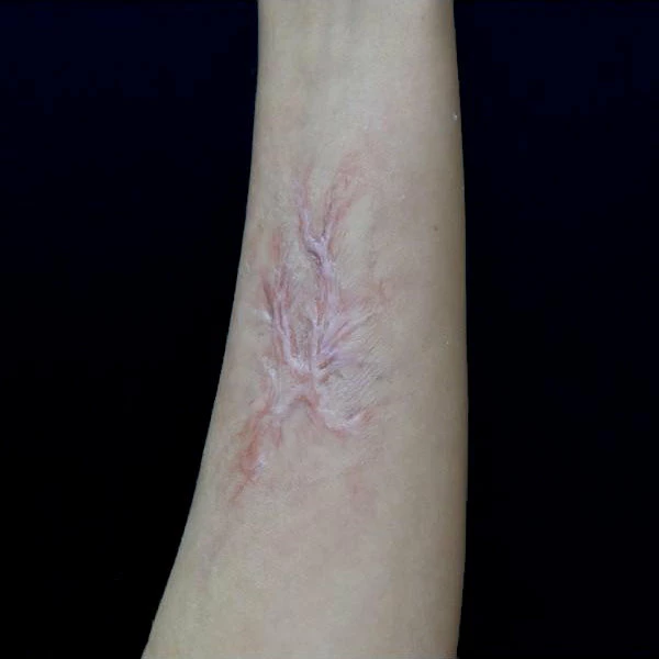 Out Of Kit Healed Burn Scar 3 Special FX 2 Out Of Kit Healed Burn Scar 3 Special FX